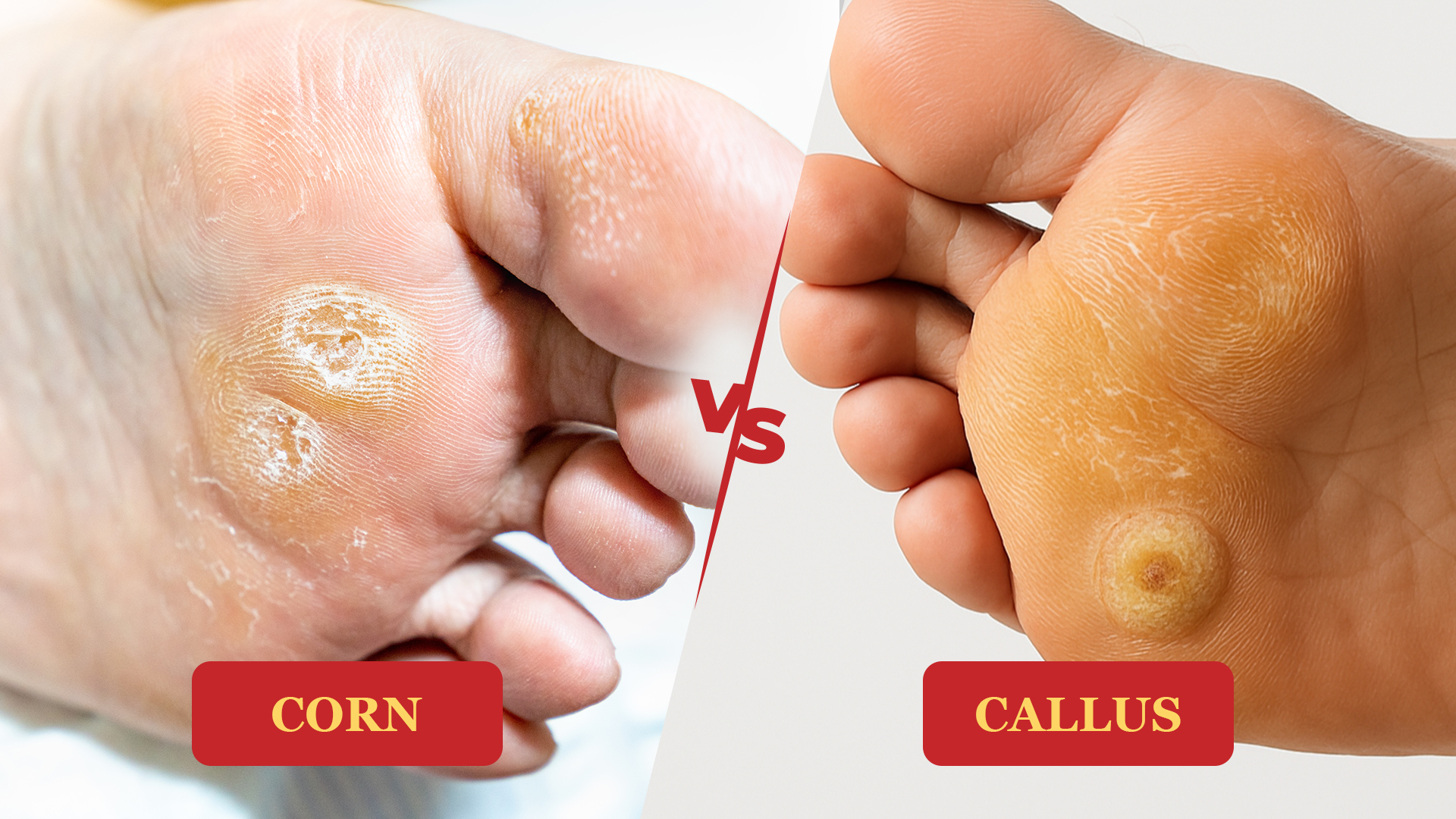 Corns And Callus